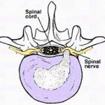 disc-hernitated